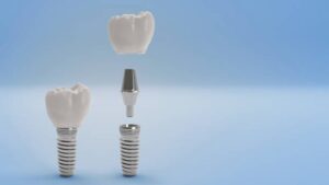 dental implants payment plan